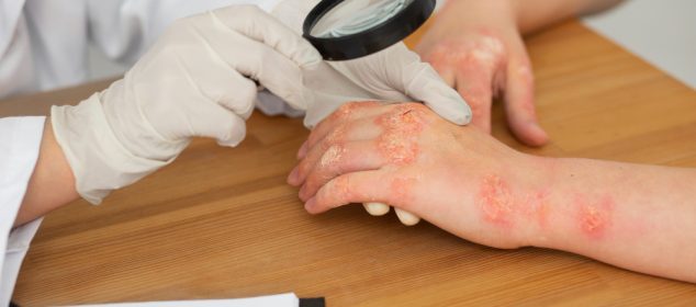 Dermatita atopică: Abordări și tratamente